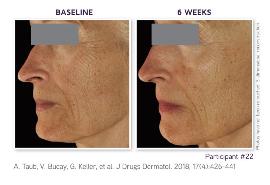 Clinical study participant 22: baseline and after 6 weeks of DefenAge